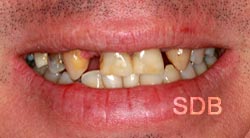 before dental bridge treatment