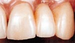 After Dental Bridge