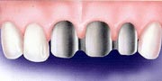 Dental Bridges procedues