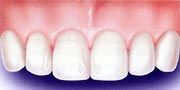 Dental Bridges procedues