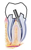 Post and core procedure