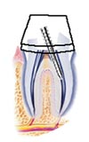 Post and core procedure