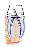 Post and core procedure