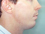 After orthognathic surgery