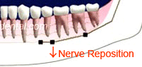 Nerve Reposition
