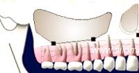 Nerve Reposition