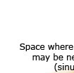 Sinus Lift