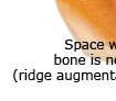 Sinus Lift