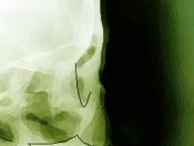 temporomandibular joint, Dental Occlusion Bangkok, Thailand