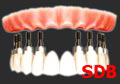 dental implant teeth in an hour Thailand