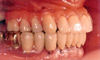 Teeth-in-an-Hour treatment