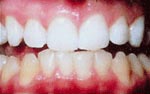 After teeth whitening treatment