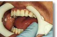 Preparation for Laser procedure