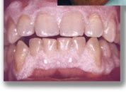Preparation for Laser procedure