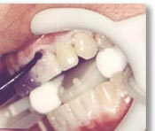Apply specially formulated gel to teeth