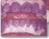 Apply specially formulated gel to teeth