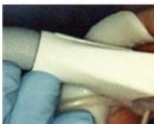 Laser Teeth Whitening treatment