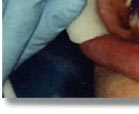 Laser Teeth Whitening treatment