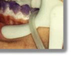 Laser Teeth Whitening treatment