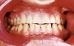 Before Laser Tooth Whitening