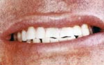 After Laser teeth whitening thailand, dental makeover thailand