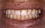 Before Laser Tooth Whitening