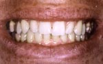 After Laser tooth whitening bangkok dental, smile makeover bangkok dental
