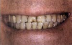 Before Laser Tooth Whitening