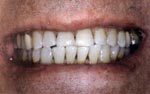 After Laser Tooth Whitening