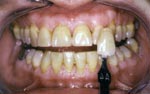 Before Laser teeth whitening bangkok clinic, smile makeovers bangkok clinic