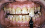Before Laser Tooth Whitening