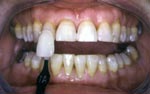 After Laser Tooth Whitening