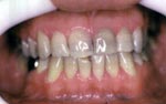 Before Laser Tooth Whitening