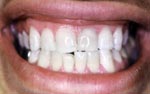 After Laser teeth whitening bangkok, dental extreme makeover thailand