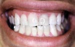 After Laser Tooth Whitening