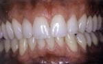 Before Laser tooth whitening center, dental extreme makeovers bangkok center