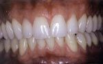 Before Laser Tooth Whitening