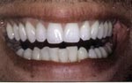 After Laser tooth whitening, dental extreme makeovers bangkok