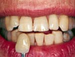 Before BriteSmile Teeth Whitening