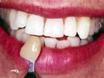 After BriteSmile Teeth Whitening