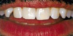 After teeth whitening treatment