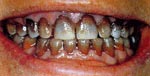 Before Dental Veneers, Porcelain Veneer Bangkok Dental Center