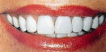 After Dental Veneer, Veneer or Facing Dental Bangkok Thailand