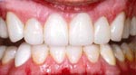 After Dental Veneer, Veneer or Facing Dental Bangkok Thailand