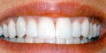 After Dental Veneer, Veneer or Facing Dental Bangkok Thailand