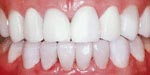 After Dental Veneer, Veneer or Facing Dental Bangkok Thailand