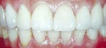 After Dental Veneer, Veneer or Facing Dental Bangkok Thailand