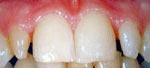 Before Dental Veneers, Porcelain Veneer Thailand Dental Center