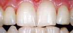 After Dental Veneer, Veneer or Facing Dental Bangkok Thailand