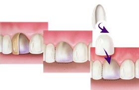 Veneer treatment